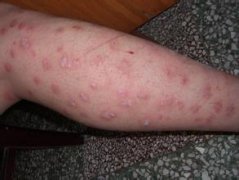 广州肤康皮肤病医院