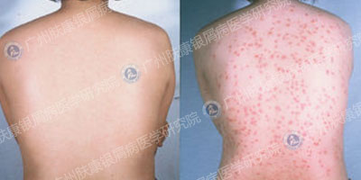 广州肤康皮肤病医院