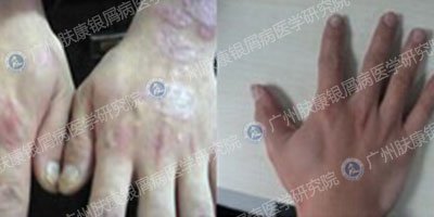 广州肤康皮肤病医院