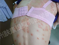 广州肤康皮肤病医院