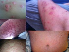 广州肤康皮肤病医院