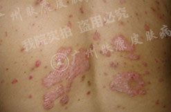 广州肤康皮肤病医院