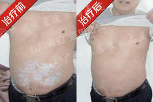 广州肤康皮肤病医院