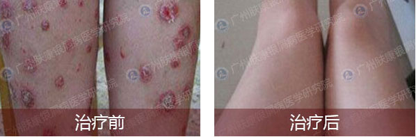 广州肤康皮肤病医院