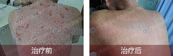 广州肤康皮肤病医院