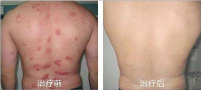 广州肤康皮肤病医院